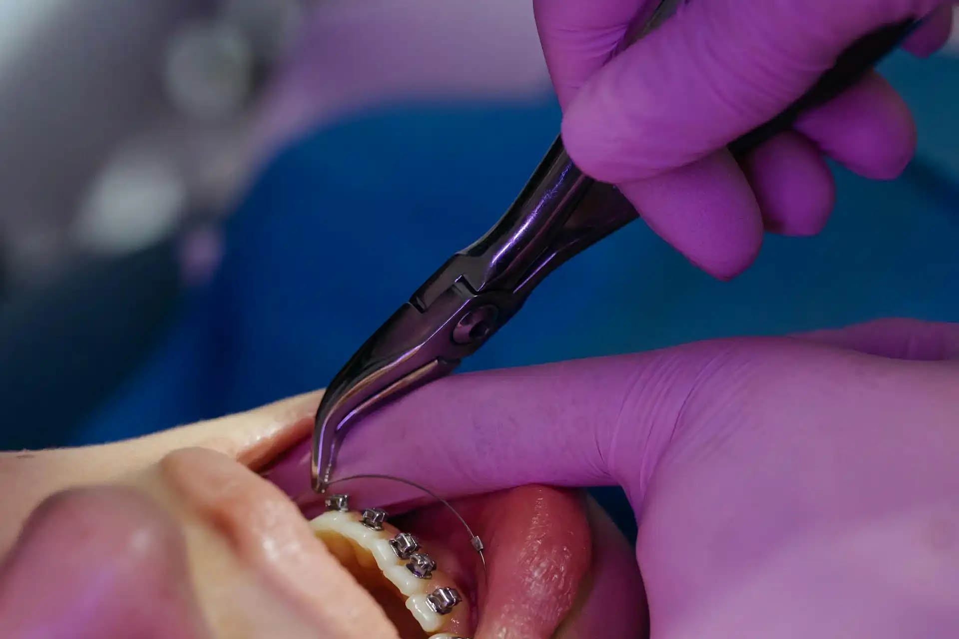 ortodontska terapija