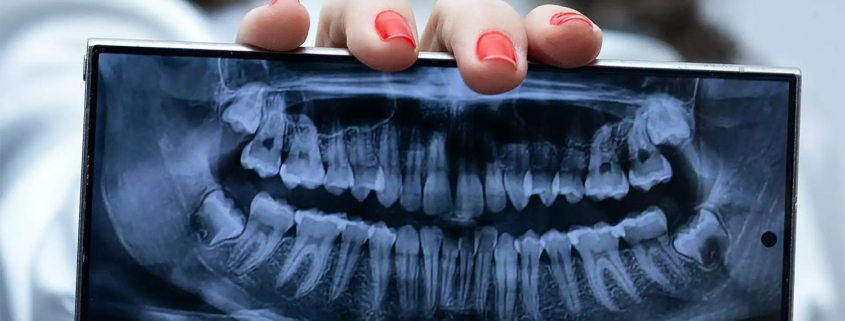 Problemi TMZ (temporomandibularnog zgloba)