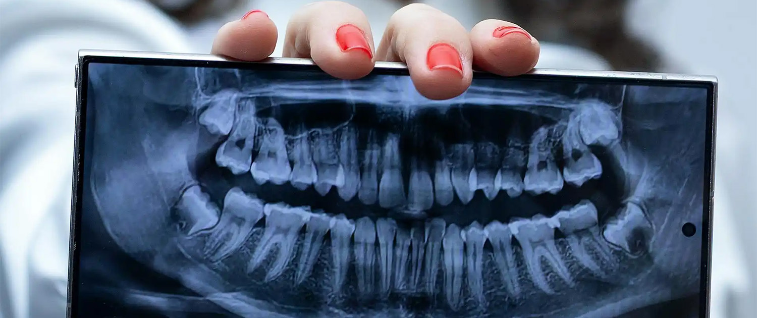 Problemi TMZ (temporomandibularnog zgloba)