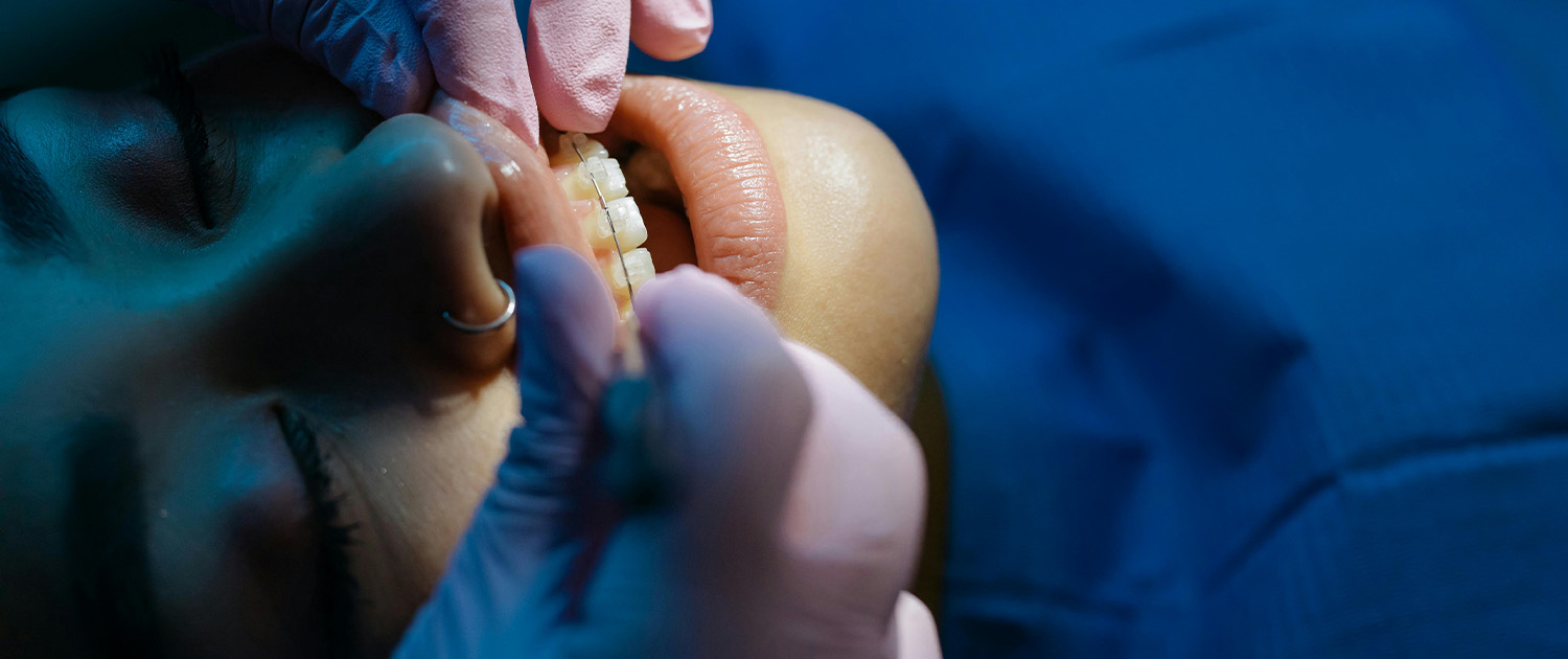 Stavljanje fikisnog aparatića