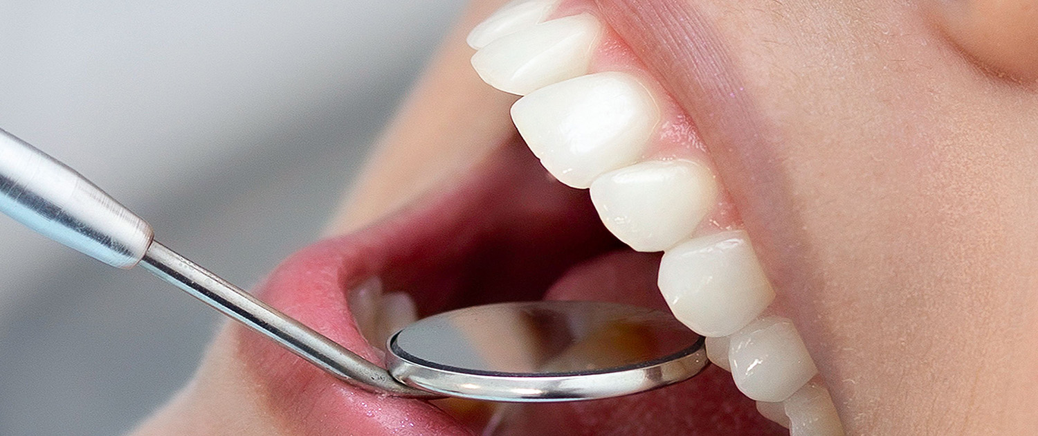 retainer nakon aparatića retainer nakon aparatića